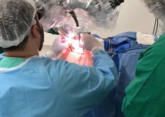 HCN realiza sua primeira cirurgia de clipagem de aneurisma